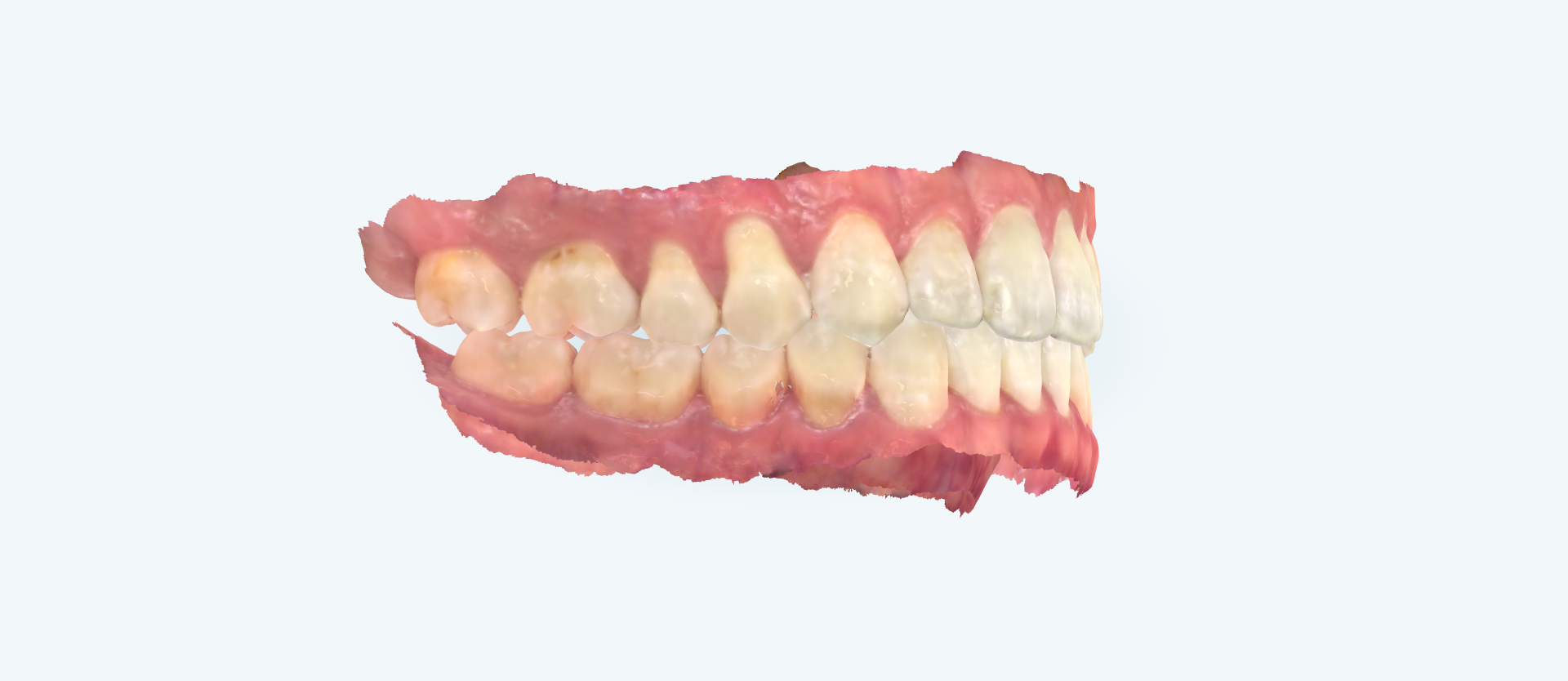 Crossbite treatment comparison case 1 after